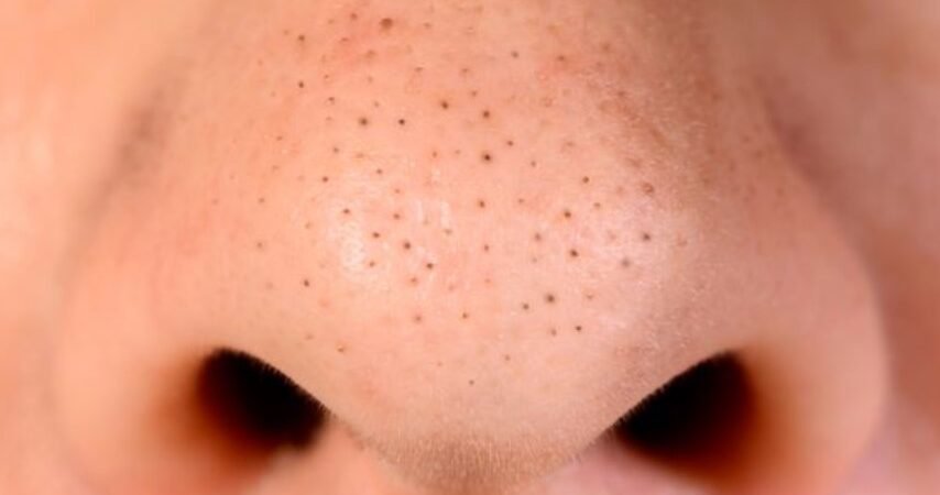 Panduan Lengkap Mengatasi Komedo Hitam atau Blackheads