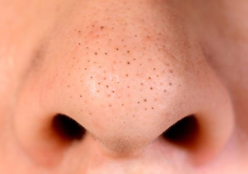 Panduan Lengkap Mengatasi Komedo Hitam atau Blackheads