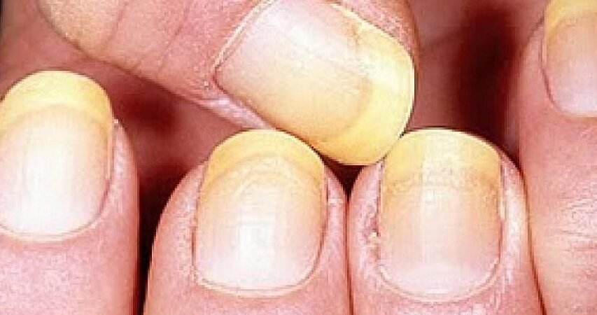 Panduan Lengkap Cara Menghilangkan Noda Kuning pada Kuku