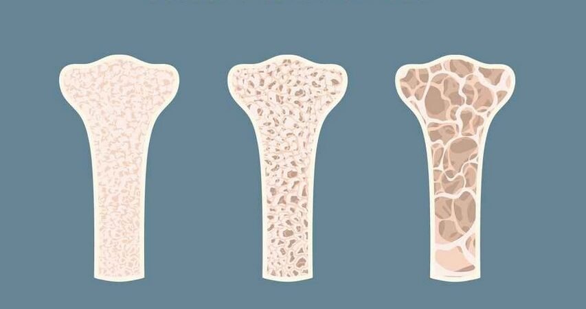 Membangun Tulang Kuat Sejak Dini dan Mencegah Osteoporosis dengan Makanan Sehat