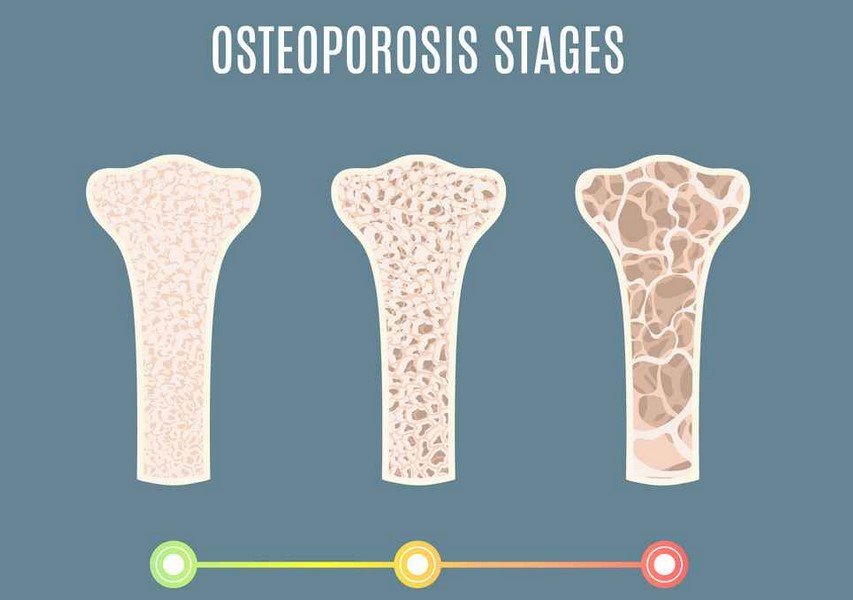 Membangun Tulang Kuat Sejak Dini dan Mencegah Osteoporosis dengan Makanan Sehat